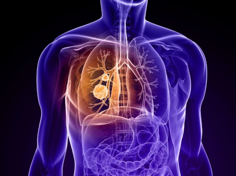 Цей день в історії: 12 листопада – Всесвітній день боротьби з пневмонією