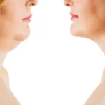 омолодження шиї