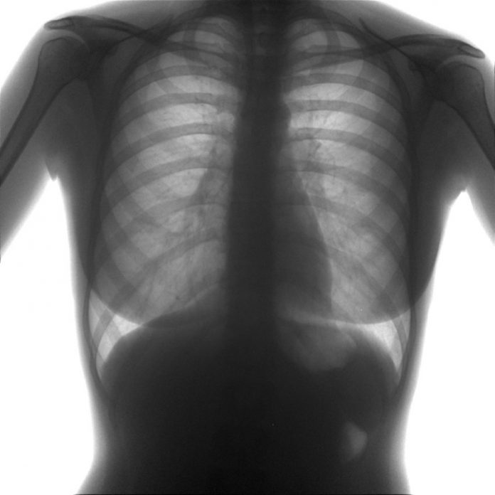 Гарантирует ли флюорограмма отсутствие туберкулеза?