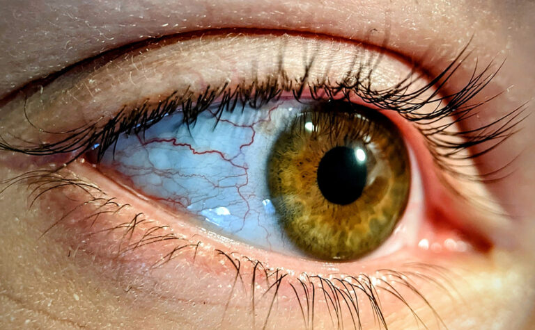 Яке сьогодні свято: 6 березня – Всесвітній день боротьби з глаукомою