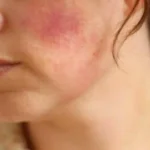 холодовая аллергия