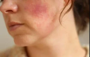 холодовая аллергия