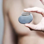 Кардіостимулятор