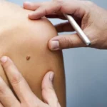 Почему возникает рак кожи