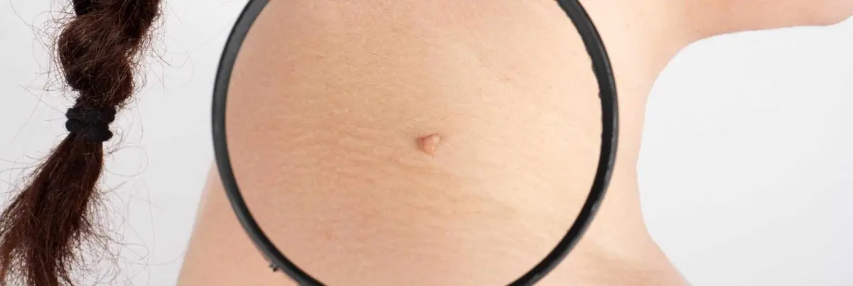 Как выглядит плоскоклеточная карцинома