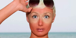 Обгоревшее лицо