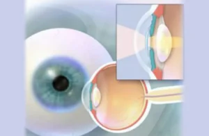 Рефракційна заміна кришталика ока