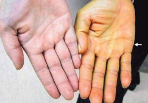 Синдром Жильбера