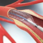 стентування судин