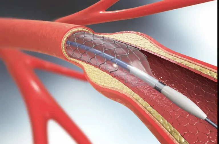 стентирование сосудов