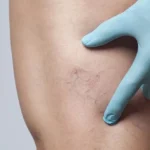 судинні зірочки