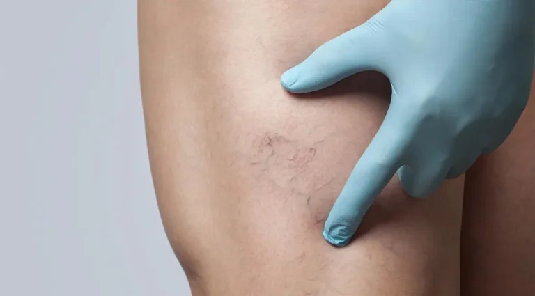 судинні зірочки