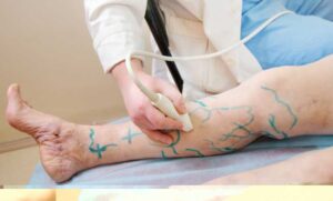 Варикоз и операция